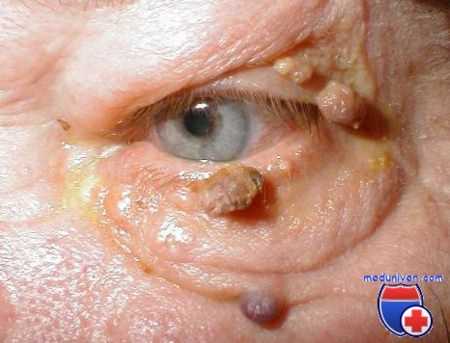 бородавки века глаза