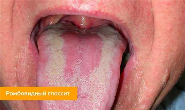 Фото ромбовидного глоссита