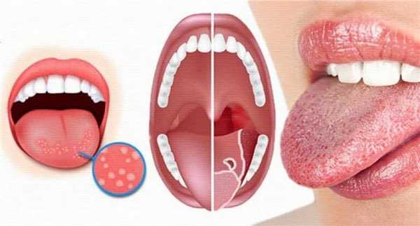 Глоссит: симптомы и причины