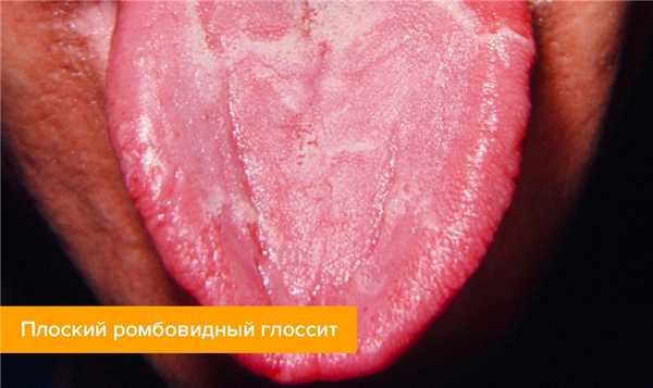Фото плоского ромбовидного глоссита