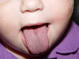 Глоссит: симптомы и причины