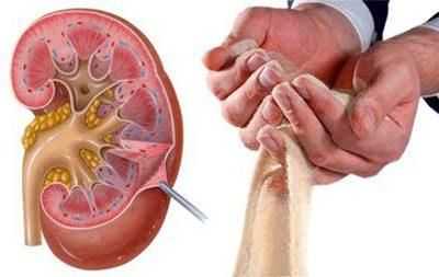 Песок в почках