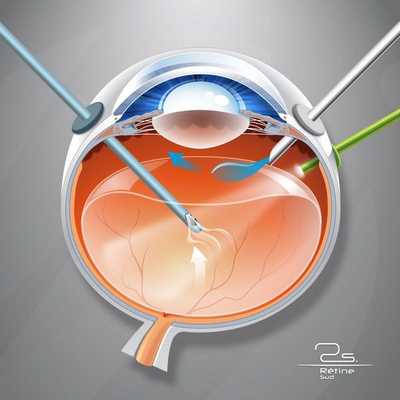 Витрэктомия