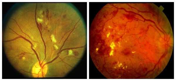 Вторая стадия заболевания