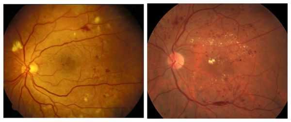 Первая стадия заболевания