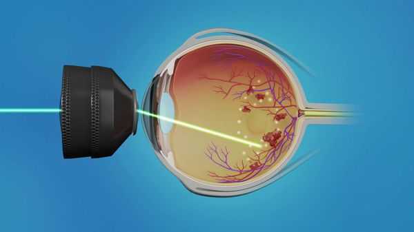 Лазерная коагуляция сетчатки