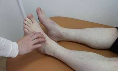 Диабетическая ангиопатия ног