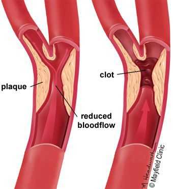 Стеноз и закупорка артерий