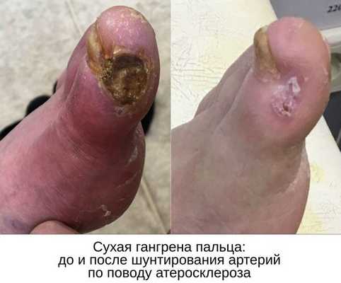 До и после шунтирования артерий