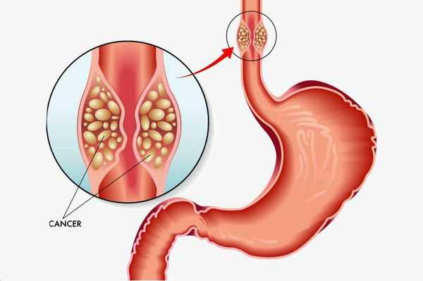Рак стенки пищевода
