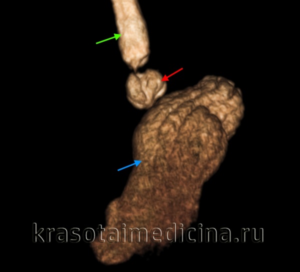 КТ ОБП (3D-реконструкция) пищевода и желудка. Аксиальная грыжа пищеводного отверстия диафрагмы, пищеводно-желудочный переход и кардия (красная стрелка) в грудной полости. Желудок (синяя стрелка), пищевод (зеленая стрелка).