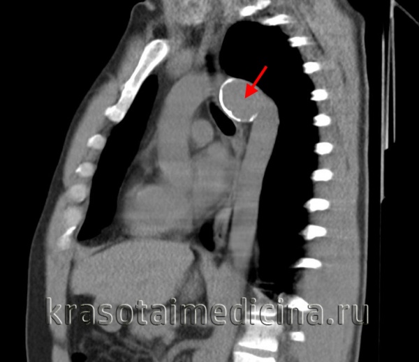 Аневризма брюшной аорты