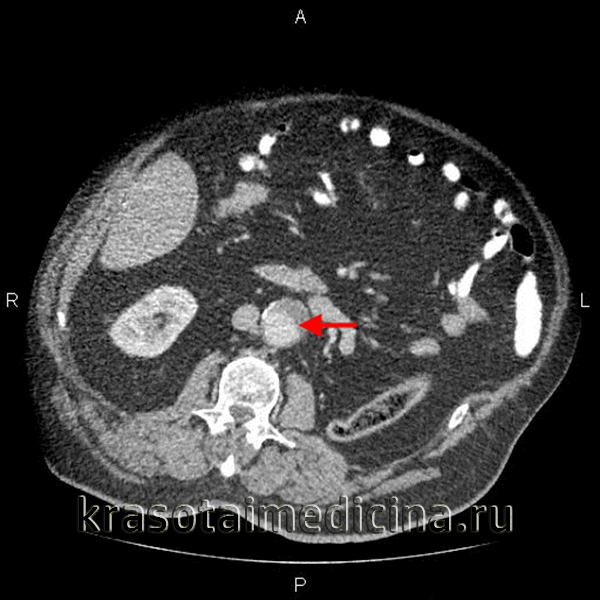 Аневризма аорты