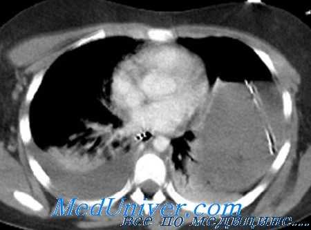 лапаротомия при травме живота