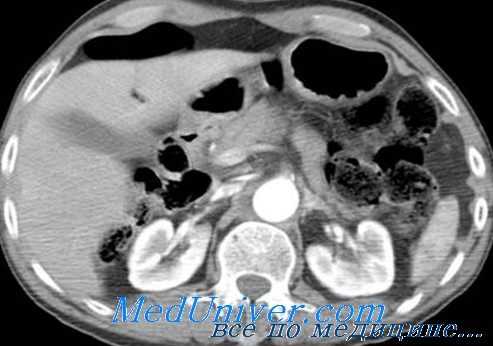 лапаротомия при травме живота