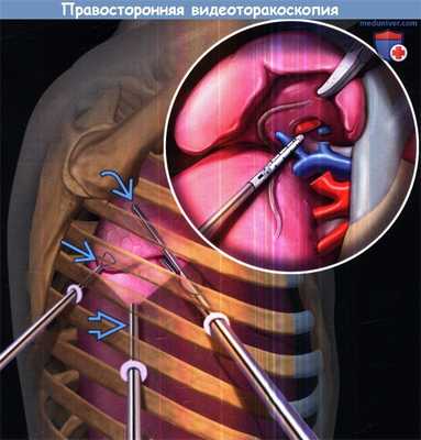 Правосторонняя видеоторакоскопия (ВТС)