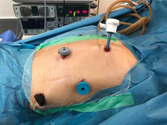 Торакоскопическая операция