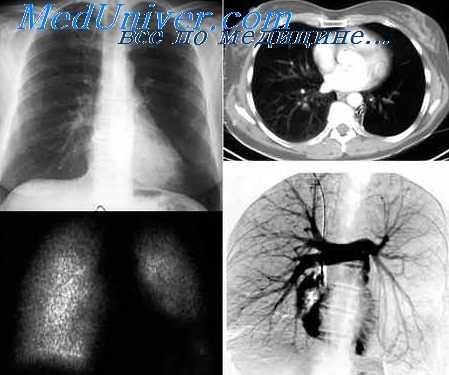 торакоскопия