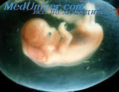 амниоцентез при двойне