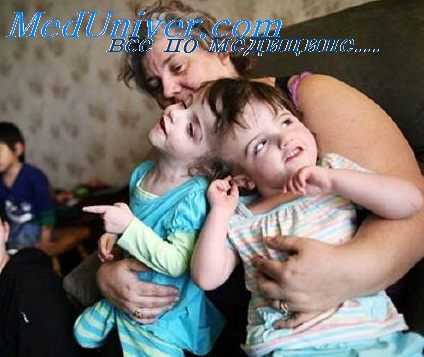 неразделившиеся двойни