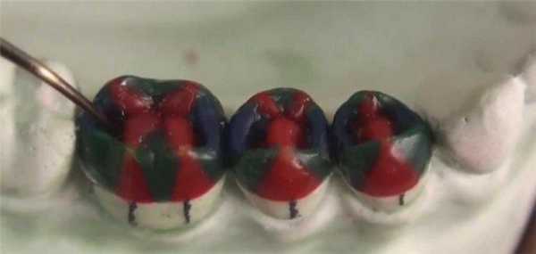 Непрямой метод моделирования зубов