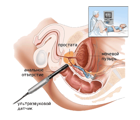 Аденома предстательной железы: диагностика и лечение