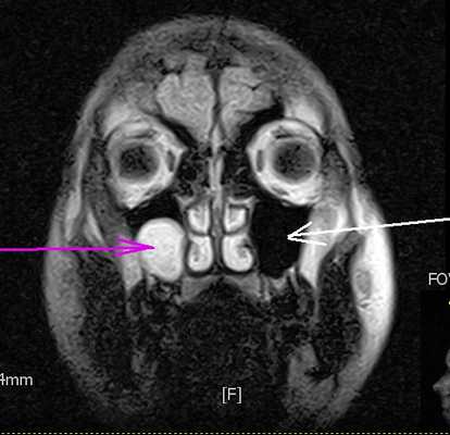 КТ полипа верхнечелюстной пазухи
