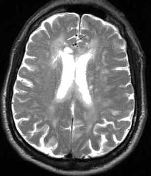 алкоголизм