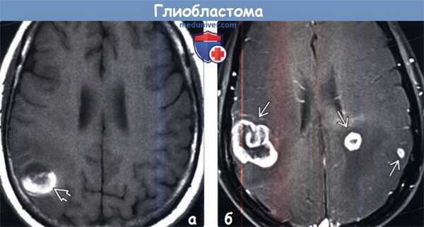Глиобластома на МРТ