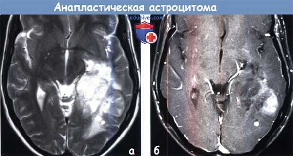 Анапластическая астроцитома на МРТ