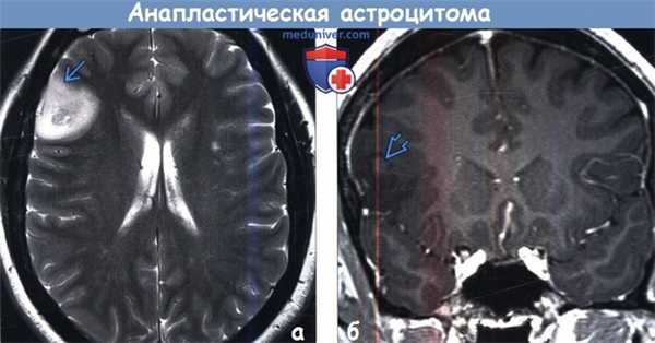 Анапластическая астроцитома на МРТ