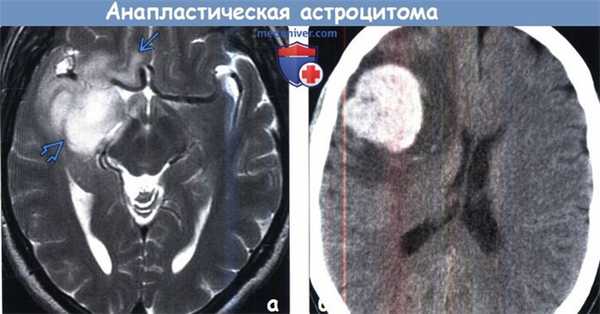 Анапластическая астроцитома на МРТ
