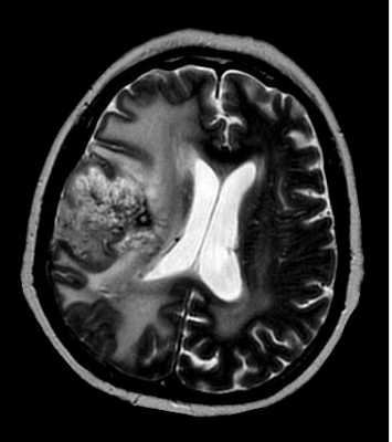 олигодендроглиома