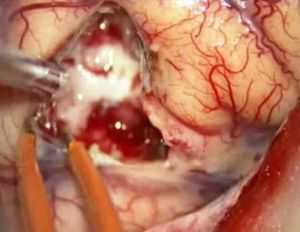 Хирургическое вмешательство