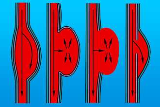 Как образуется аневризма