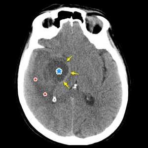 глиобластома КТ