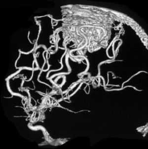сосудистая мальформация на МРТ