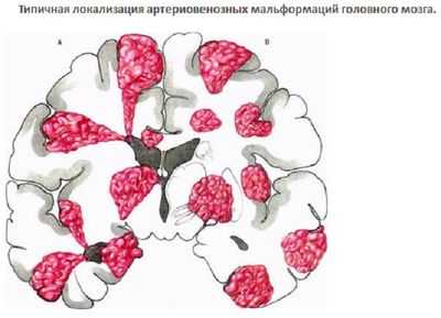 Артериовенозная мальформация