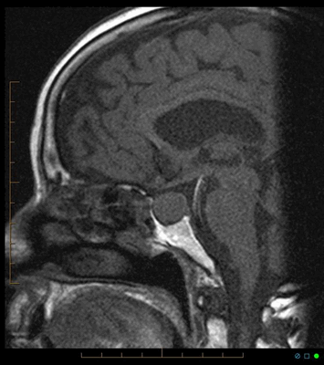 Аденома гипофиза на МРТ