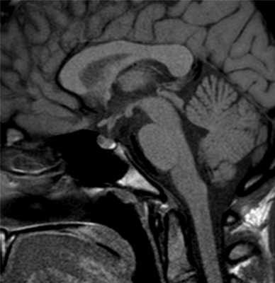 Киста кармана Ратке на МРТ