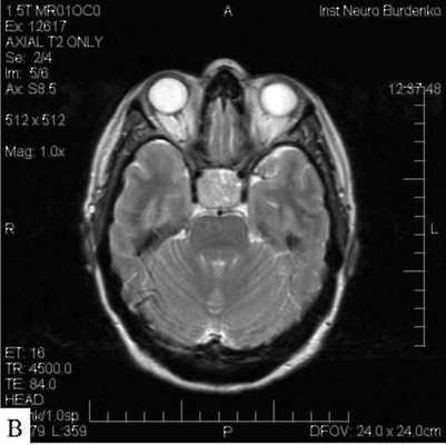 Макроаденома гипофиза на снимке МРТ