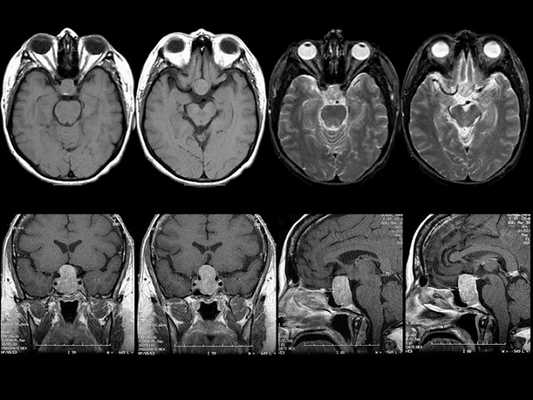 Микроаденома гипофиза на МРТ