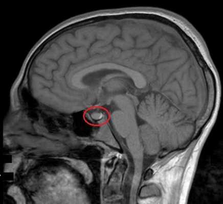 МРТ гипофиза