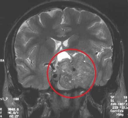 МРТ гипофиза