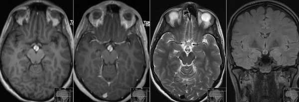 Признаки новообразования в области турецкого седла на снимке МРТ