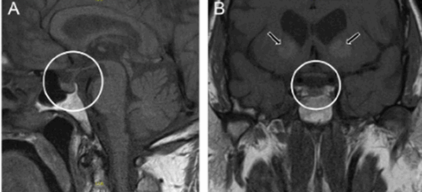 МРТ гипофиза с контрастом и без