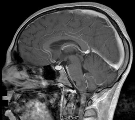 МРТ гипофиза с контрастом