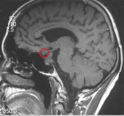 МРТ гипофиза