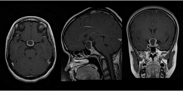 МРТ гипофиза