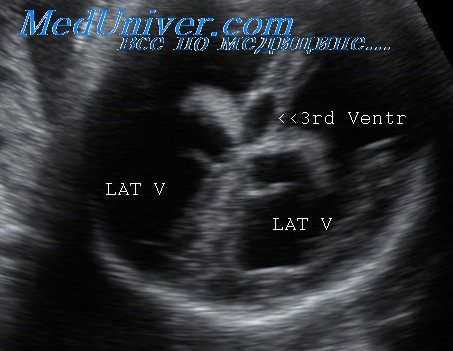 аномалии развития плода